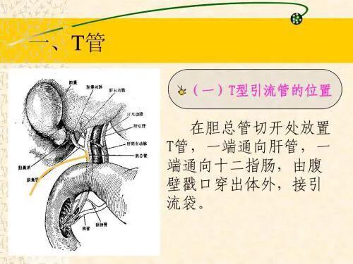 胆道术后t管堵塞的处理,胆道镜术后t管拔管时间
