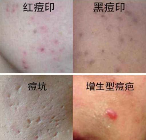 脸上痘印多久会自行消失,在脸上挤痘痘留下的痘印会消失吗