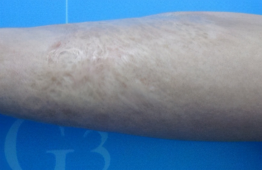 去除陈旧疤痕真正有效的方法,祛除陈旧手术疤痕多少钱