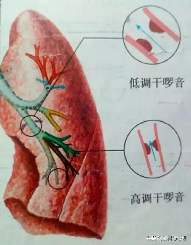 湿啰音干啰音都是什么声音,干啰音和湿啰音什么意思