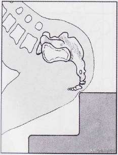 屁股蹲地上了尾骨很痛咋办,一个屁股蹲造成腰椎骨折