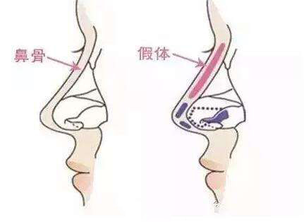 玻尿酸隆鼻效果能维持多久,玻尿酸隆鼻注意事项及禁忌