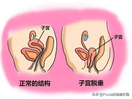 瑜伽漏尿最有效的恢复方法,治漏尿最快的瑜伽运动视频