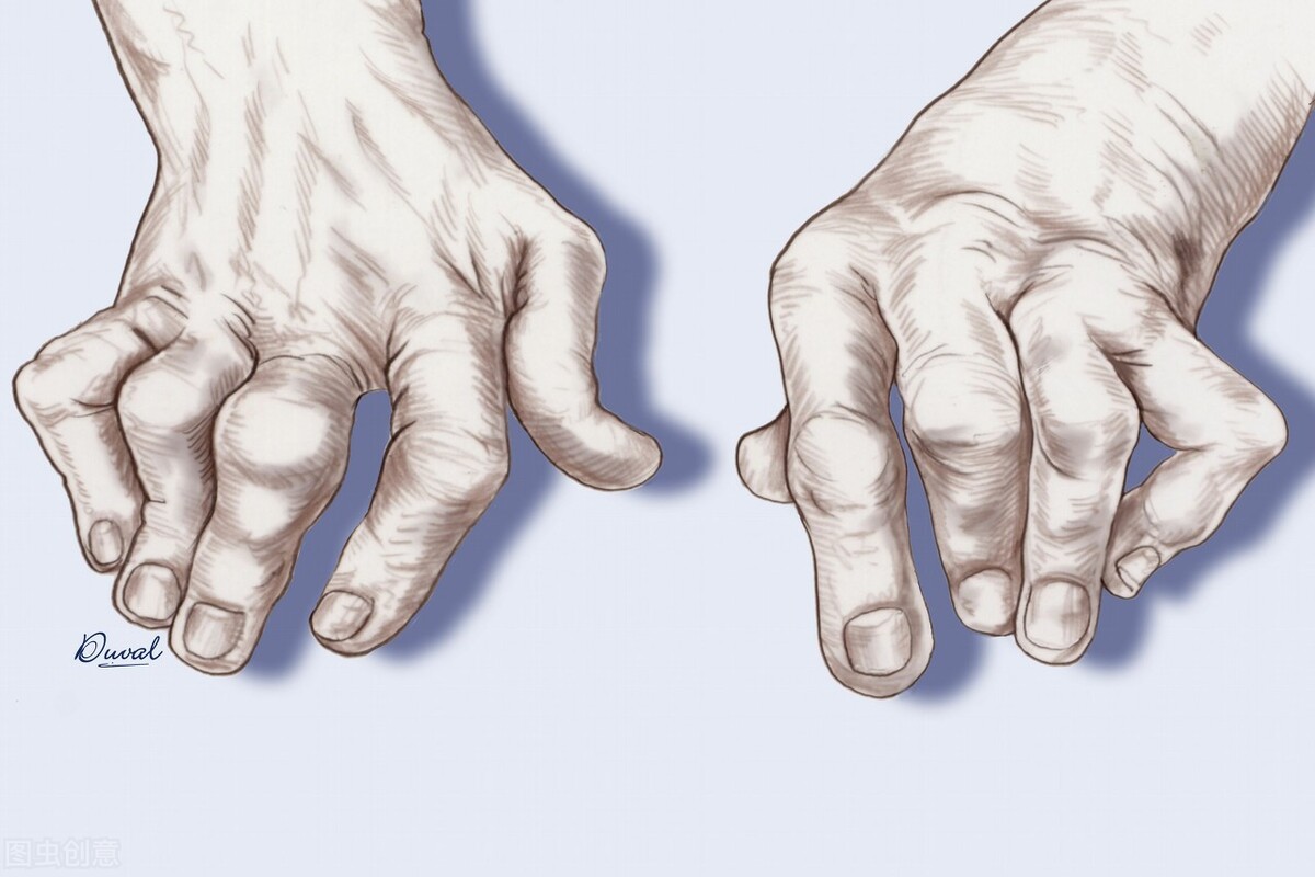 痛风如何辨证分型,痛风临床诊断治疗与建议