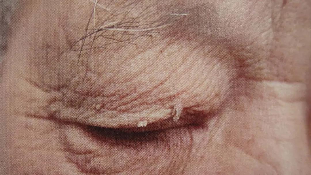 脸上长了很多小肉揪是什么东西,脸上长个小肉刺可以揪了吗