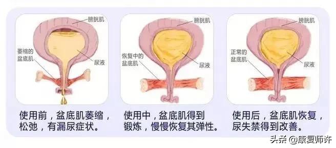 产后腹直肌分离的解决方法,产后腹直肌分离怎么处理
