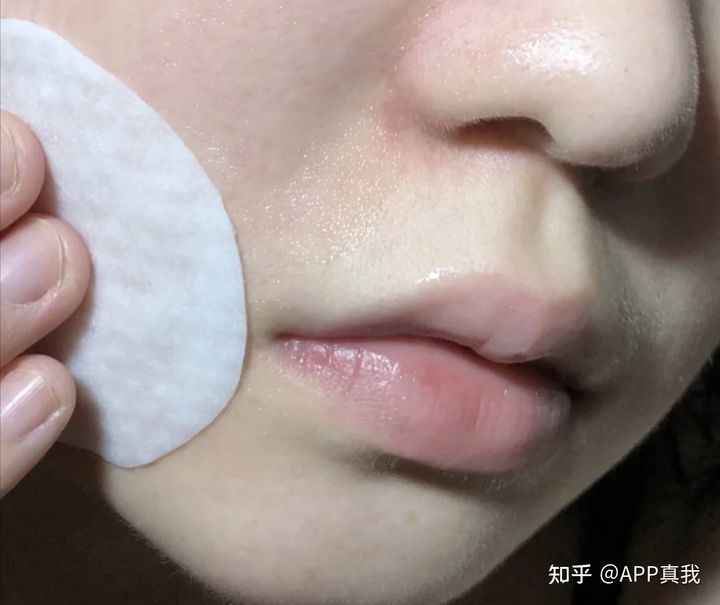 刷酸后毛孔越来越明显为什么,毛孔粗皮肤松弛有黑头适合刷酸吗