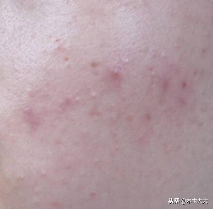 体内排毒祛痘的好方法,祛痘坑最权威有效的方法