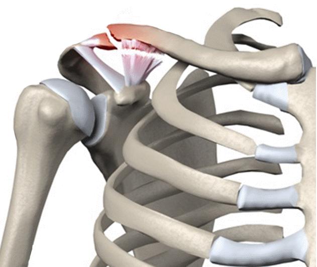 锁骨中段骨折保守治疗注意事项,儿童锁骨骨折怎么办