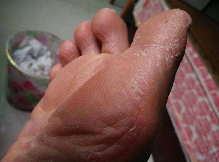 孩子手脚干燥脱皮发红怎么回事,小孩手脚脱皮是什么原因怎么治