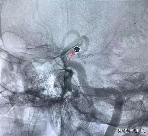 脑血管病介入治疗的介绍,缺血性脑血管病介入治疗进展2015