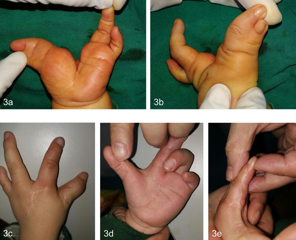 先天性并指畸形科普以及案例分享,先天性并指畸形