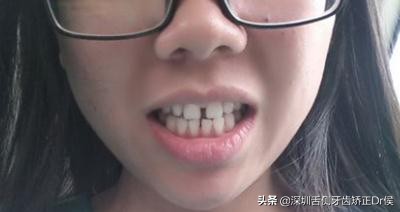 牙齿中间有黑色缝隙,牙齿有缝隙需要补吗