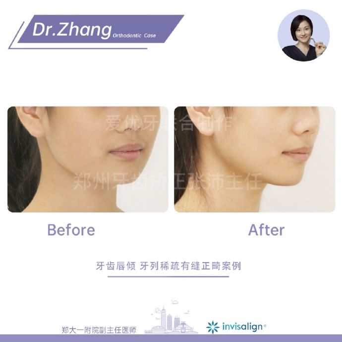 牙齿矫正郑州,郑州牙齿矫正案例合集