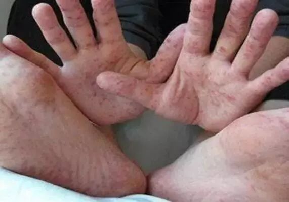 仔猪身上有出血点和结痂是什么病,孩子总是有一两个出血点反反复复