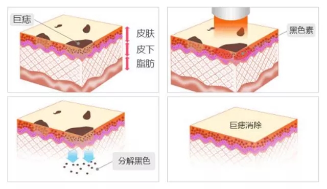 激光点肉痣会留疤吗,激光祛痣会不会留下疤痕