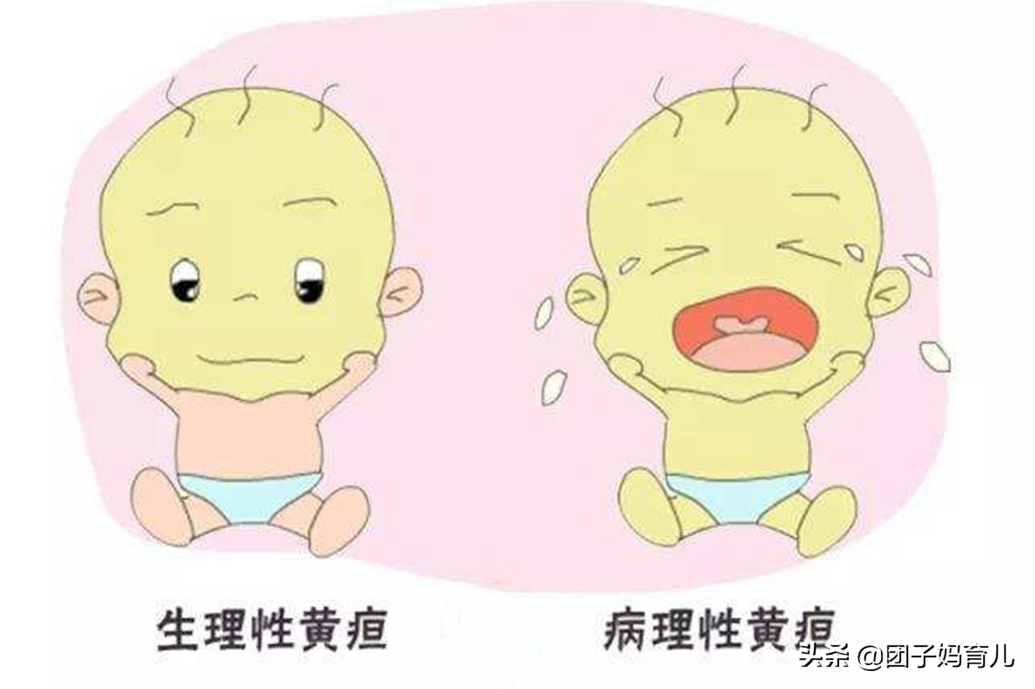 新生婴儿假性例假,新生儿来月经的症状