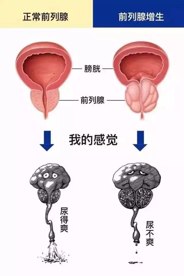 男性一般多大年纪出现前列腺增生,年轻人前列腺有点增生怎么办