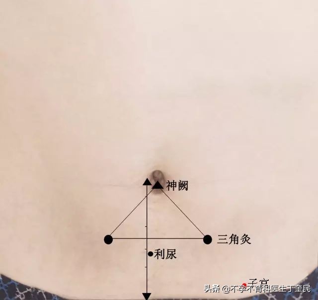 艾灸助孕穴位全图,艾灸助孕要注意什么