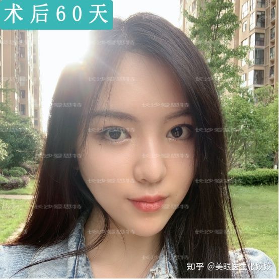 为什么割的双眼皮会显得假,为什么有的双眼皮做出来特别假