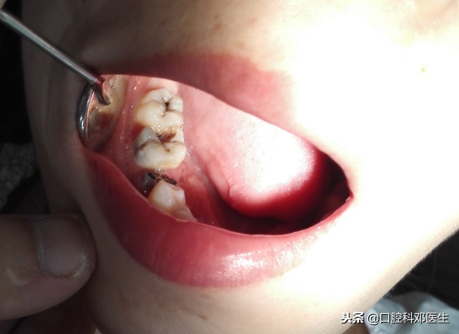 儿童蛀牙到底补好还是不补好呢,有蛀牙为什么医生建议不补牙齿