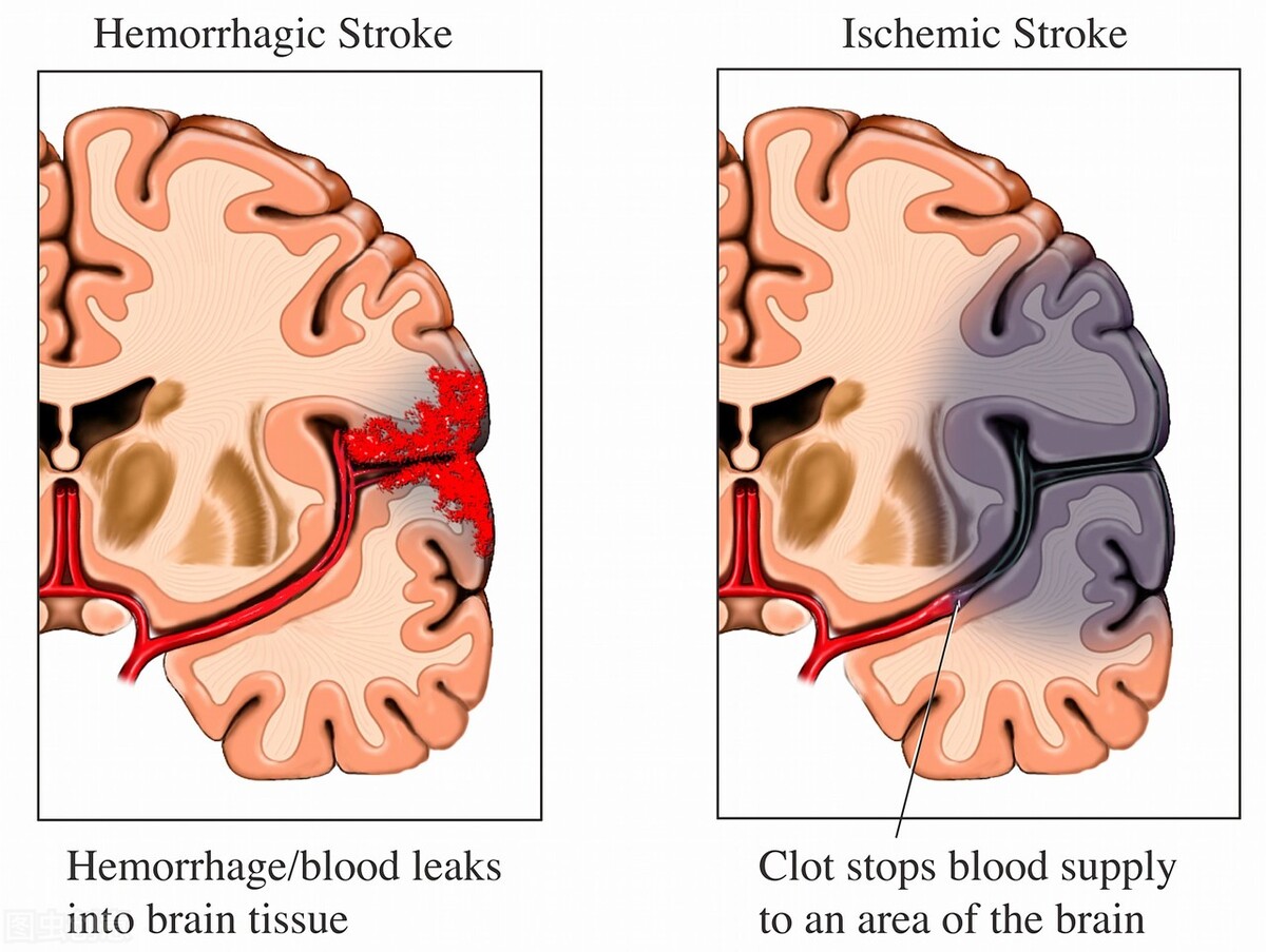 老人突然低血压中风了怎么急救,老年人的血压控制在150