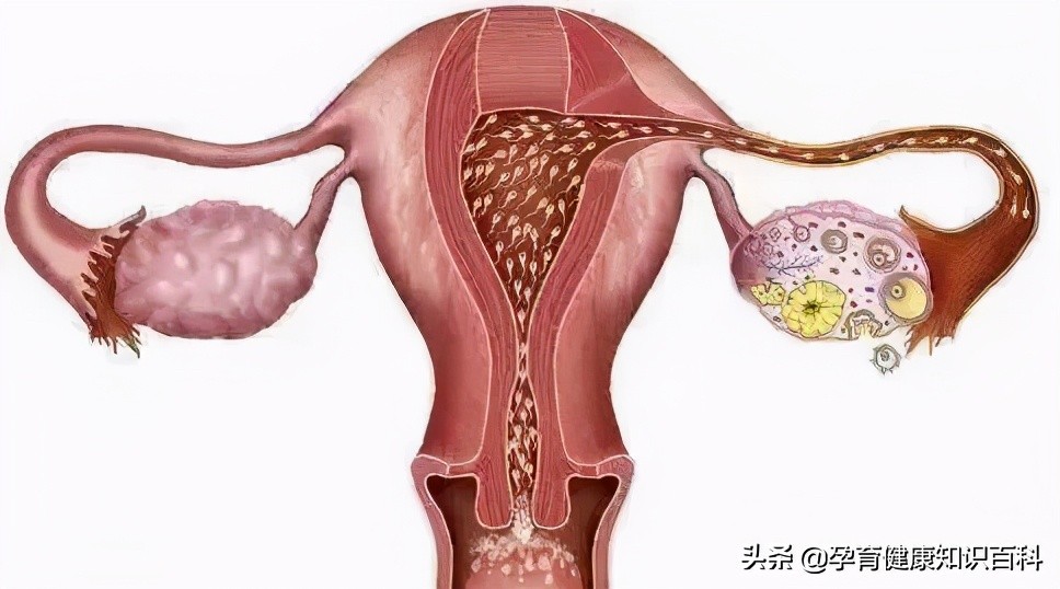 卵巢储备功能下降促排卵方案,卵巢储备功能低下的助孕策略