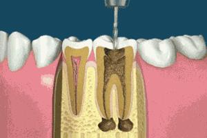 牙齿做根管治疗后补牙多少钱一颗,为什么要做根管治疗不能直接补牙