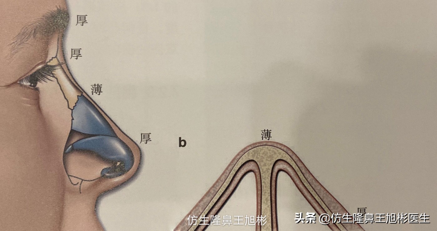 隆鼻怎么做才能让鼻型更好看,隆鼻后变老变丑