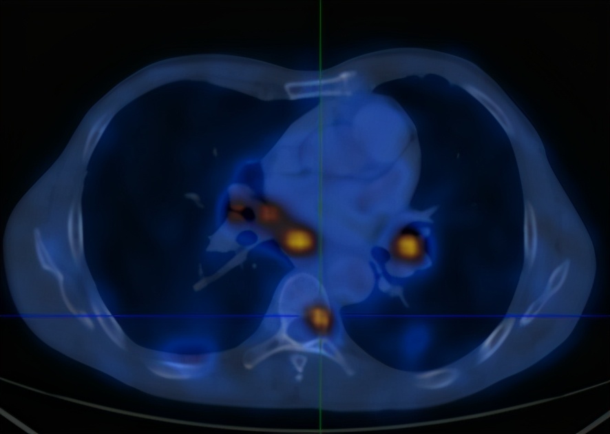 腰痛与肺癌有关吗,腰痛的厉害是得了肾癌吗