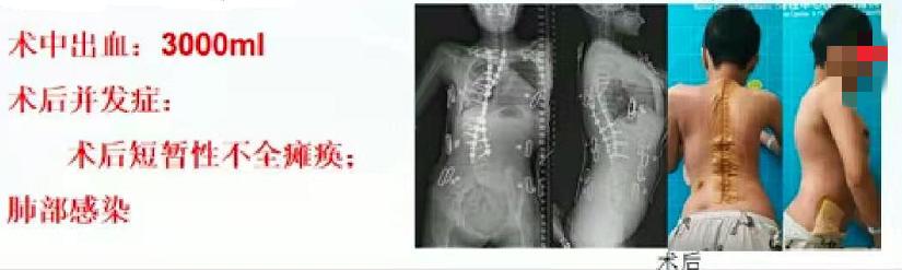 成人脊柱畸形矫形策略是什么,脊柱畸形医疗救治