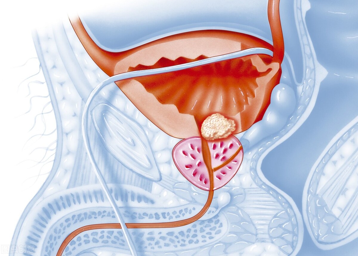 前列腺增生也太痛苦了，为什么那么难治？