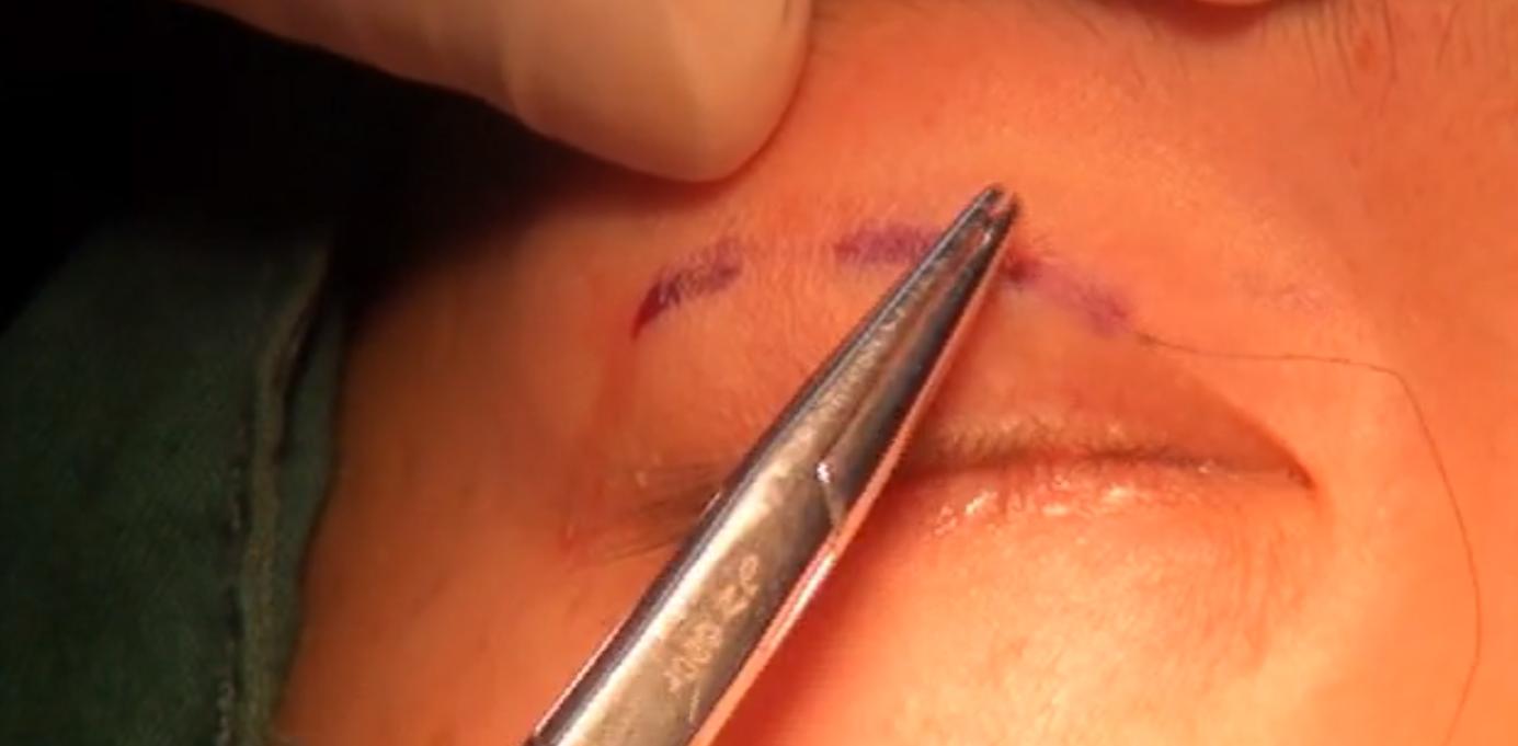 双眼皮科普小课堂：双眼皮的三种术式及术后护理