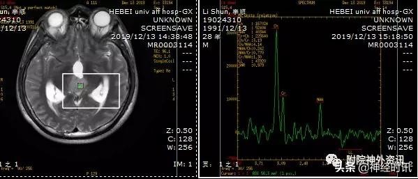 松果体占位怎样治疗,松果体区占位看什么科室