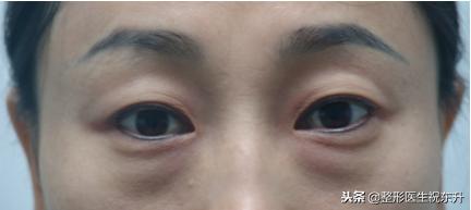 抽脂去眼袋和切口去眼袋效果对比,抽脂去眼袋后悔了