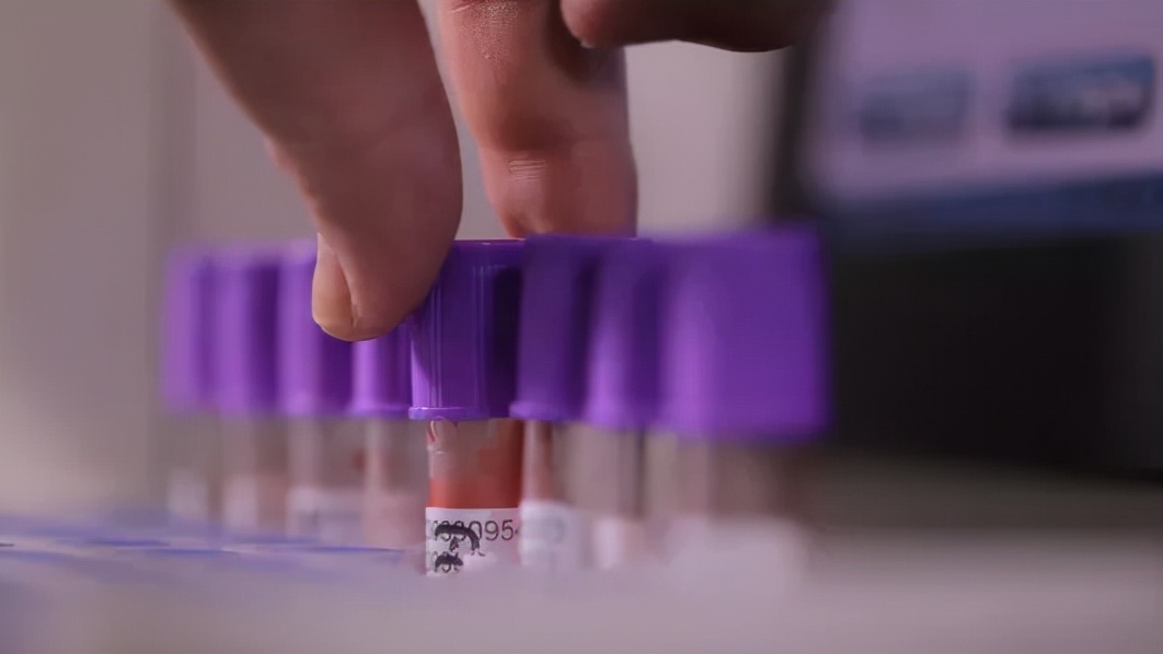 甲亢治愈的真实例子,甲亢用药过量导致甲减脖子粗