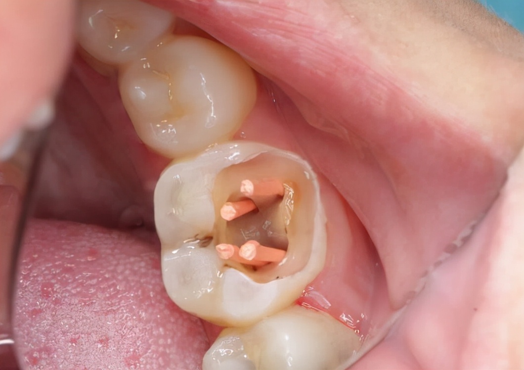 根管治疗怎样才要做,根管治疗的药不小心弄掉了