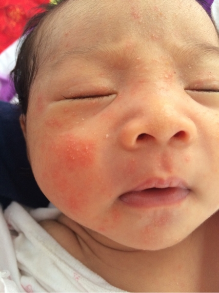 婴儿湿疹宝妈们有什么推荐,湿疹反复的宝宝宝妈怎么护理的啊