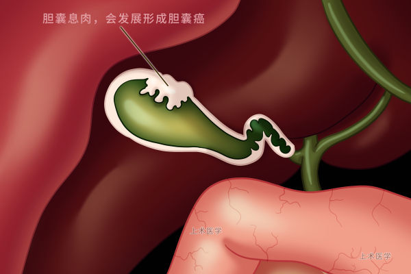胆囊息肉伴有胆囊结石怎么办,胆囊息肉胆囊结石胆囊炎吃什么药