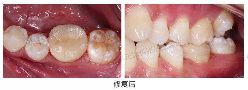 牙齿楔状缺损修复图片,牙齿楔状缺损修复大概多少钱