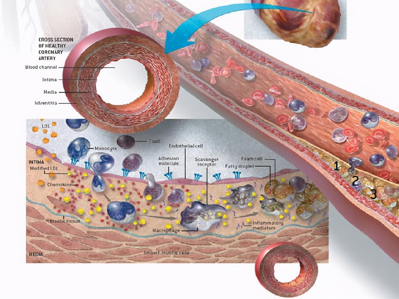 有冠心病经常害怕受惊吓怎么办,得了冠心病每天提心吊胆怎么办