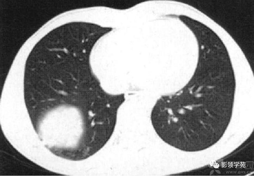 肺肉芽肿影像学表现ppt,肺韦格纳肉芽肿影像学表现