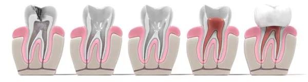 牙疼就必须做根管治疗了吗,牙疼戴牙套要根管治疗
