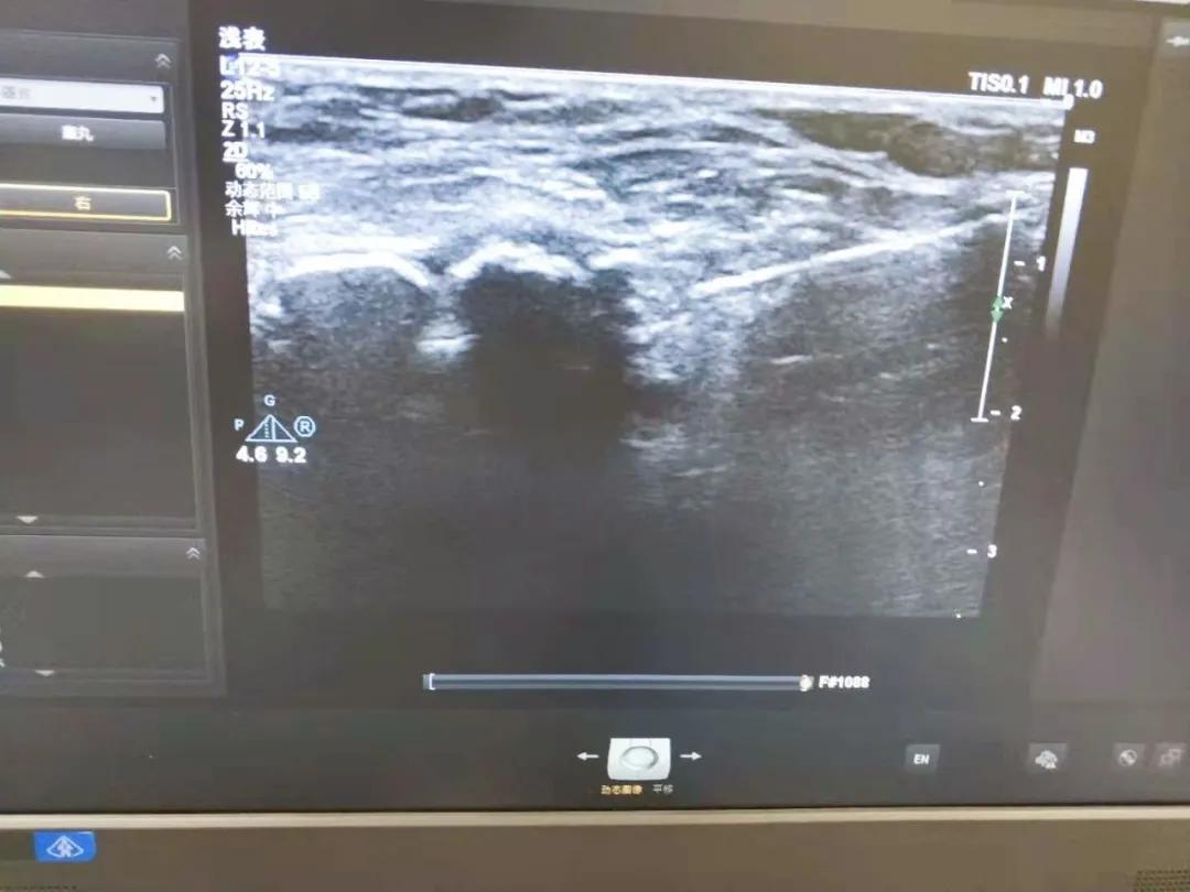 腘窝囊肿内引流术,我院完成首例上颌骨囊肿切除手术