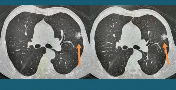 31岁肺癌自愈案例,三十岁肺癌晚期
