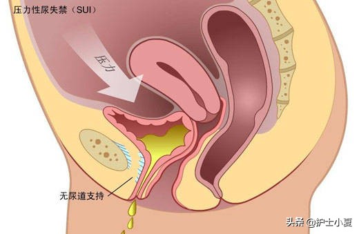 打喷嚏漏尿莫大意，盆底疾病缠住你，切勿病急乱投医，一文解难题