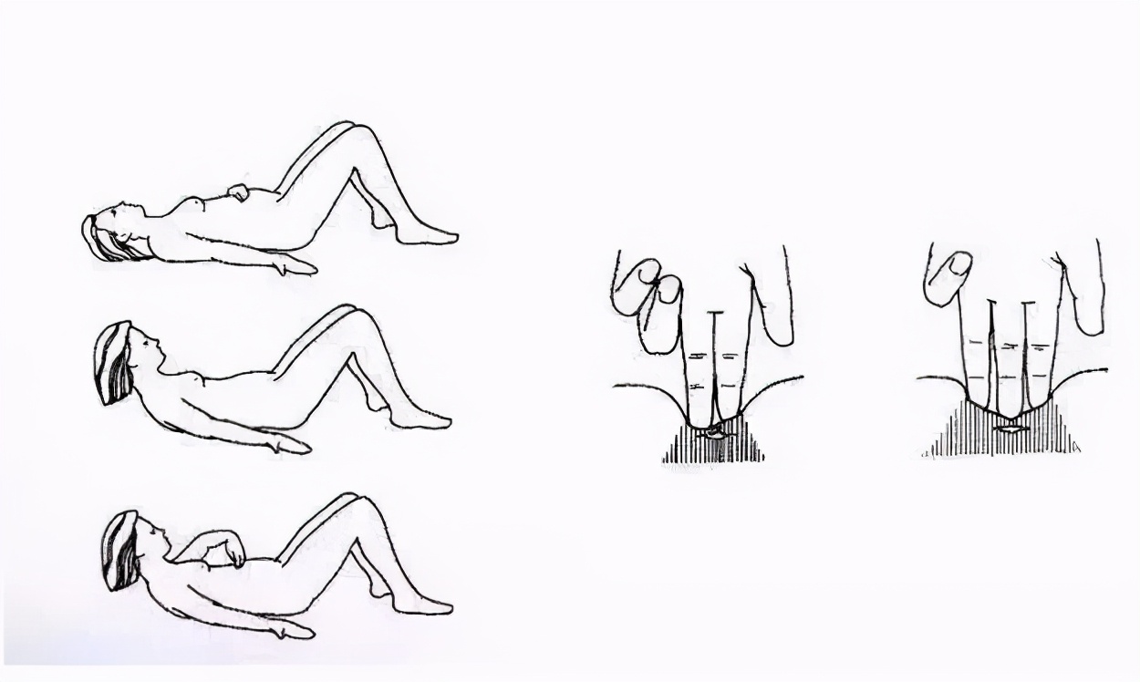 三指半到闭合,一个双胞胎妈妈的腹直肌康复之路