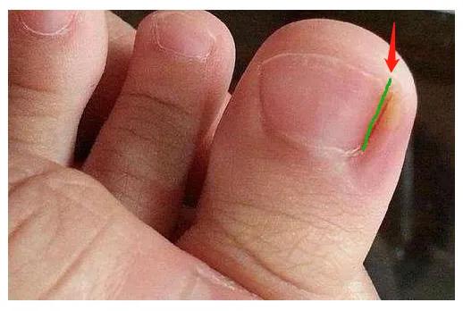 儿童怎么预防甲沟炎,美甲能预防甲沟炎吗