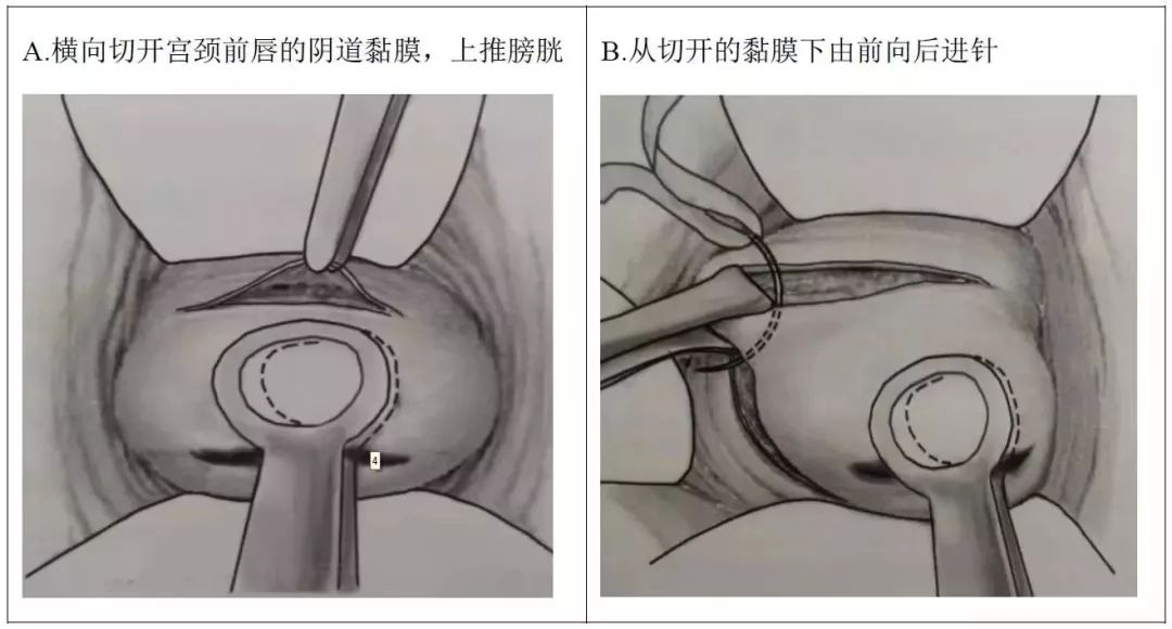 孕21周做宫颈环扎术成功率有多少,孕前腹腔镜宫颈环扎术过程及弊端