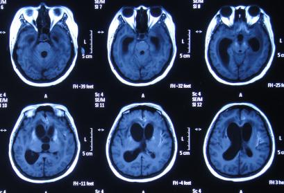 结核性脑积水,脑膜炎脑积水要治疗多久